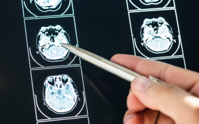 Πόσο επικίνδυνη είναι η εγκεφαλική διάσειση; Χρειάζεται να χειρουργηθώ;